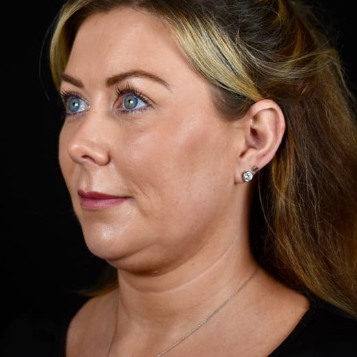 Non-surgical neck lift before