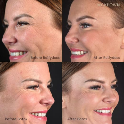 patient before and after botox & relfydess treatment