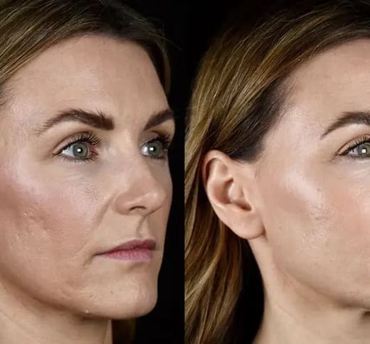a before and after photo of a female patient who has had laser resurfacing treatment at McKeown Medical.