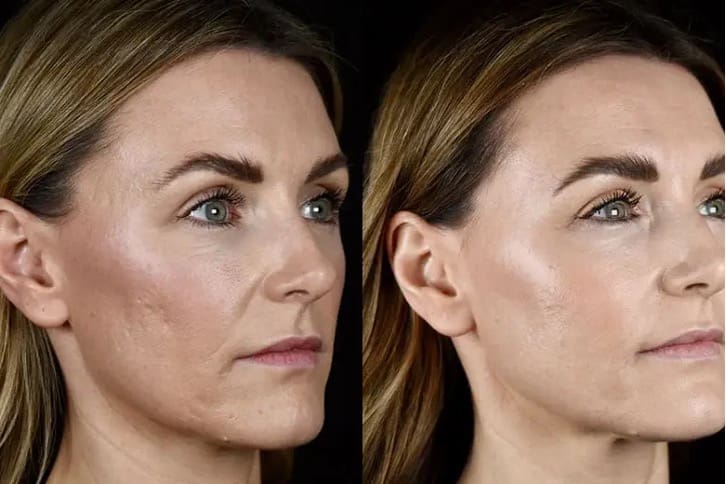 a before and after photo of a female patient who has had laser resurfacing treatment at McKeown Medical.