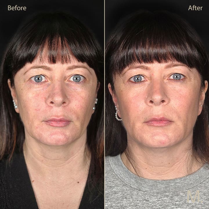 Before and after 5ml fillers