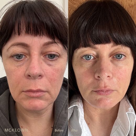 Patient before and two days after the 5ml filler protocol.