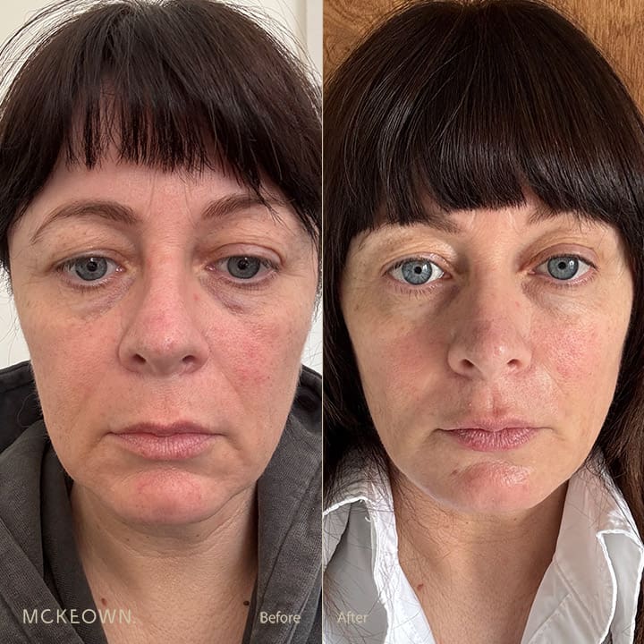 Patient before and two days after the 5ml filler protocol.