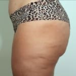 Sofwave treatment before and after