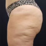 Sofwave treatment before and after