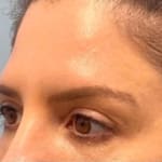 Sofwave treatment before and after