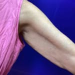 Sofwave arms treatment before and after