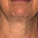Sofwave treatment before and after