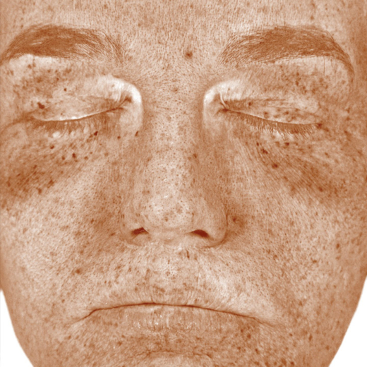 VISIA skin analysis image showing UV damage, pigmentation spots, and sun damage patterns across the face, highlighting areas of underlying skin ageing and uneven tone.